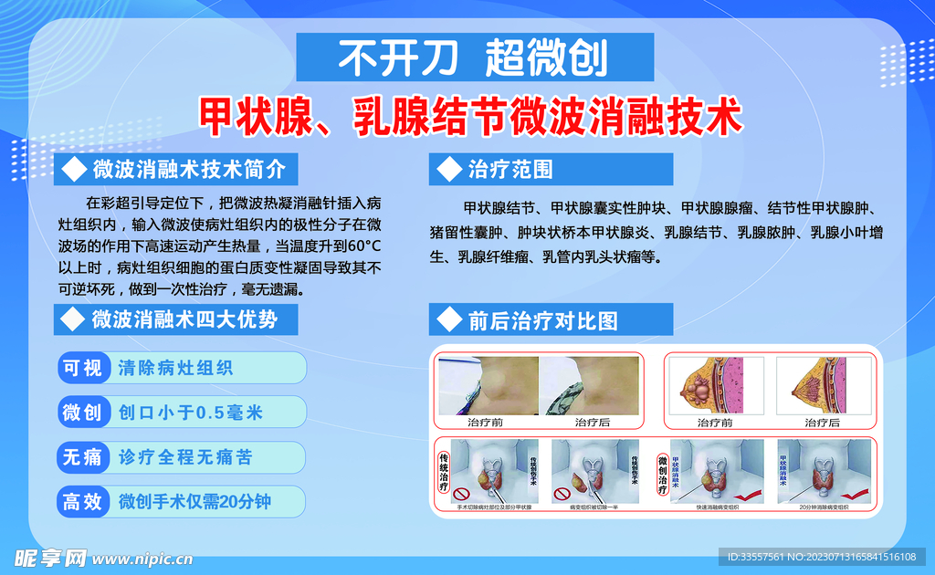 甲状腺结节治疗 微创融合术