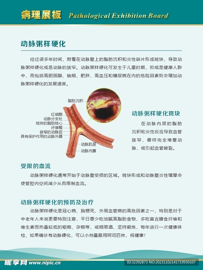 动脉粥样硬化