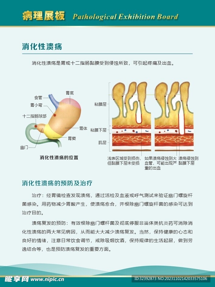 消化性溃疡