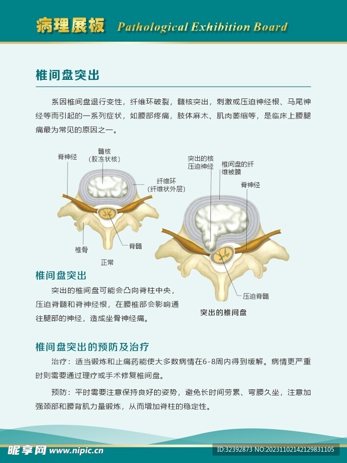 椎间盘突出