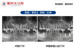 种植牙案例