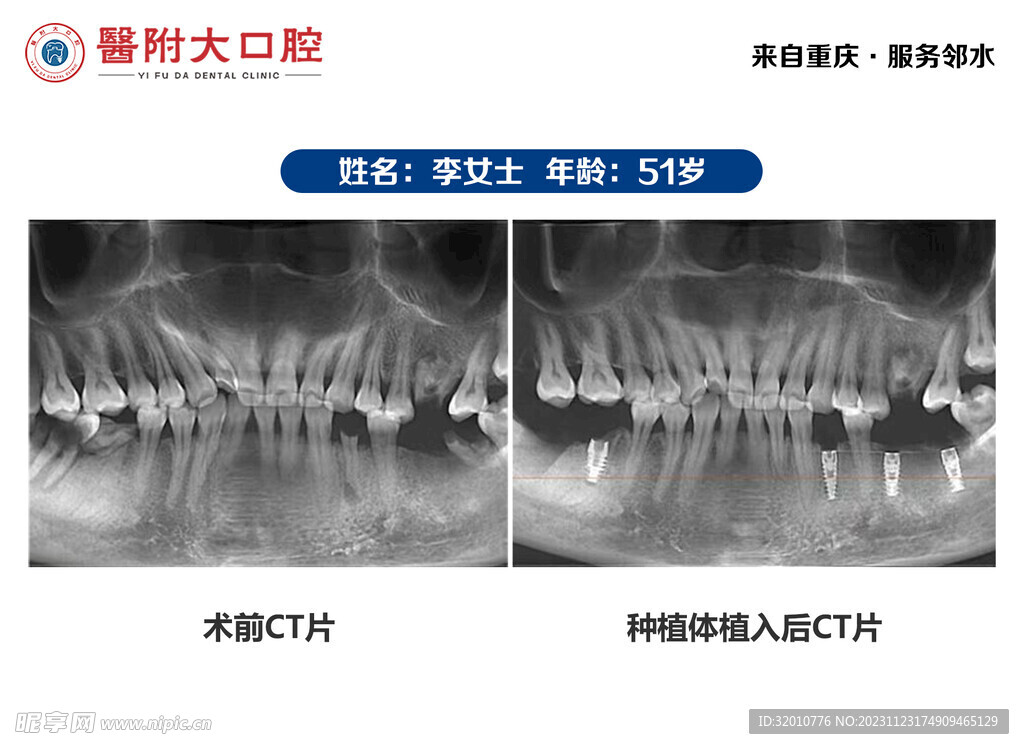 种植牙案例