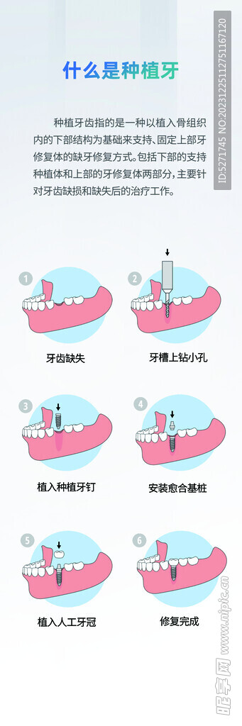 种植牙挂画