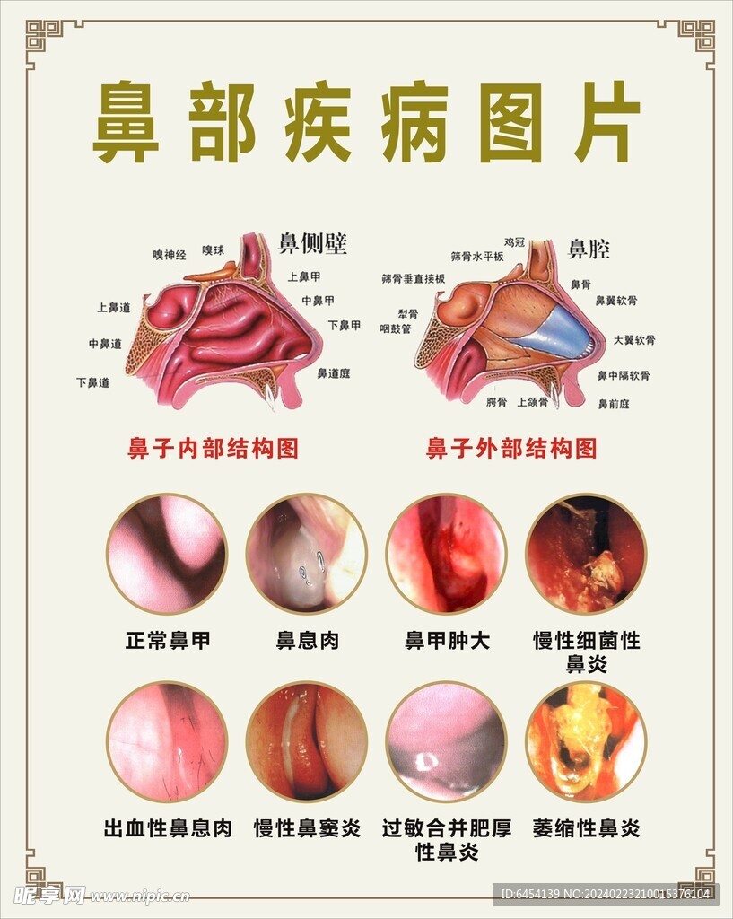 鼻部疾病图片 鼻窦炎