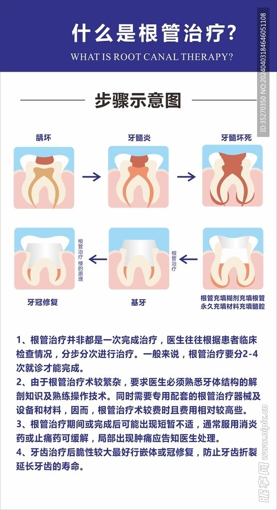 根管治疗