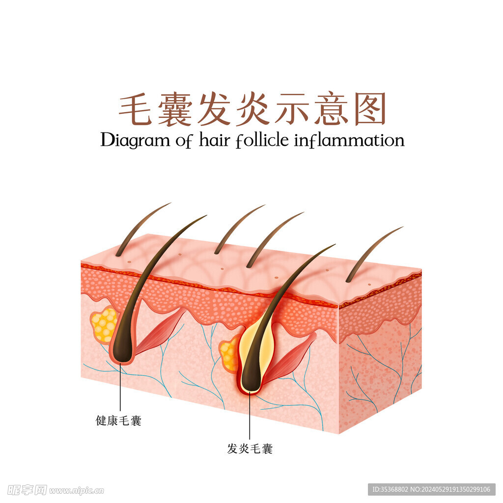 毛囊发炎对比