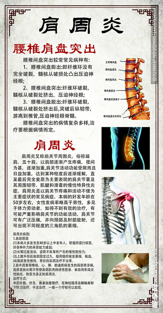肩周炎