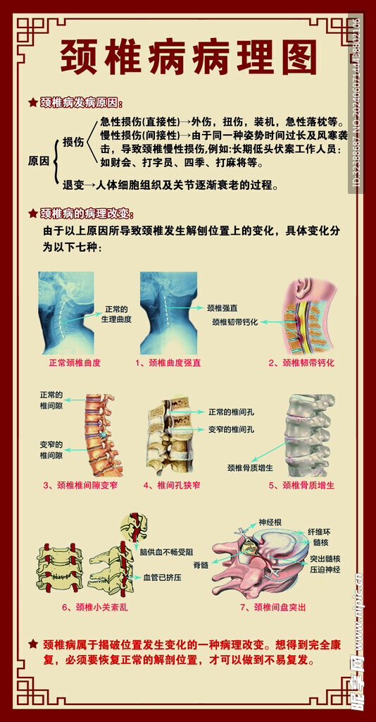 颈椎病病理图