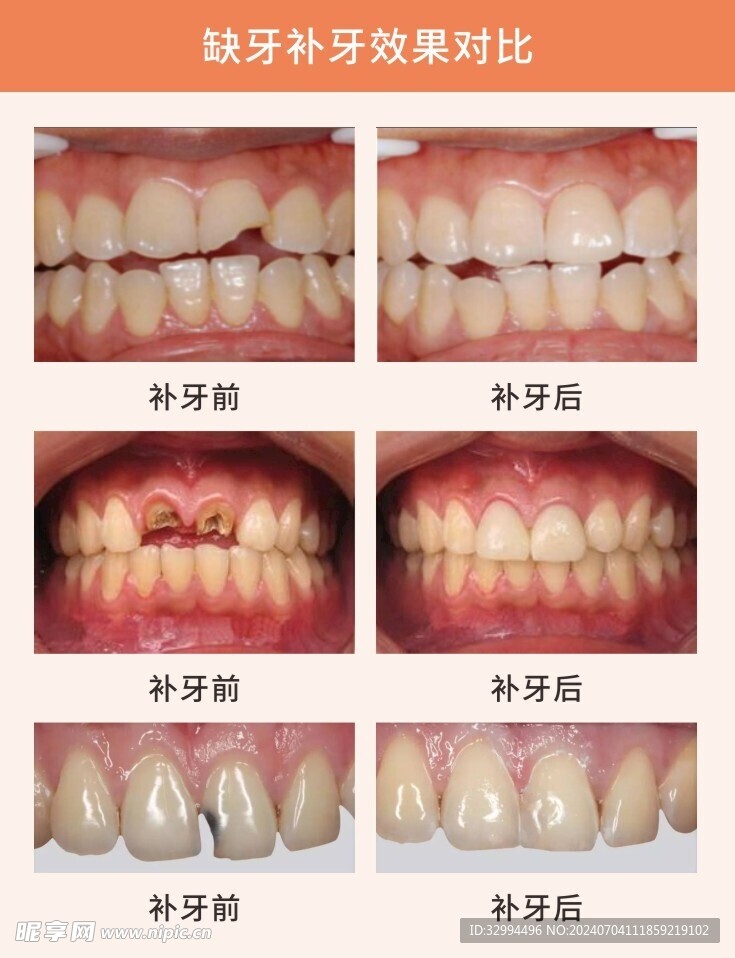 缺牙对比图