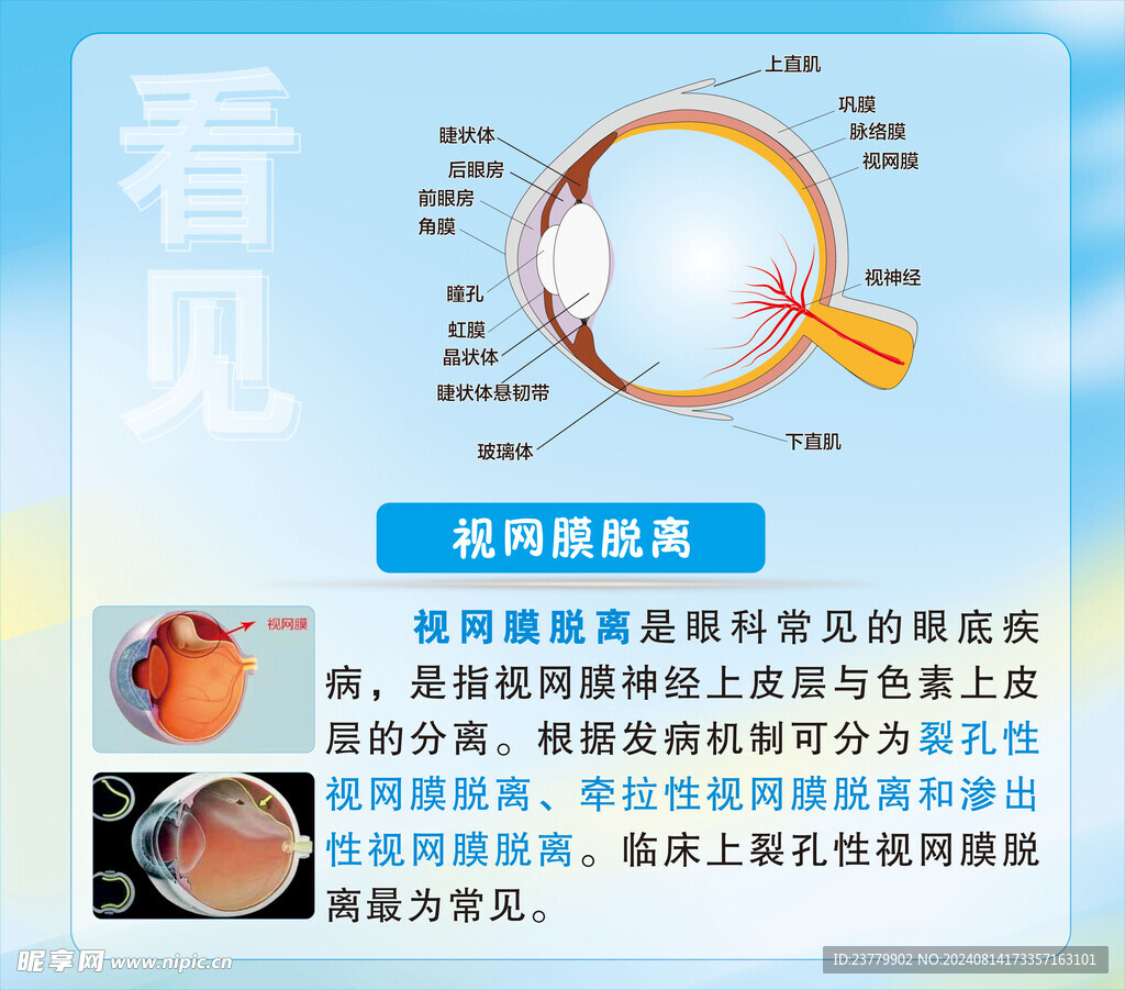 眼科医院视网膜脱离海报