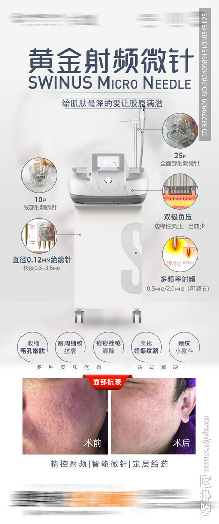 黄金射频微针