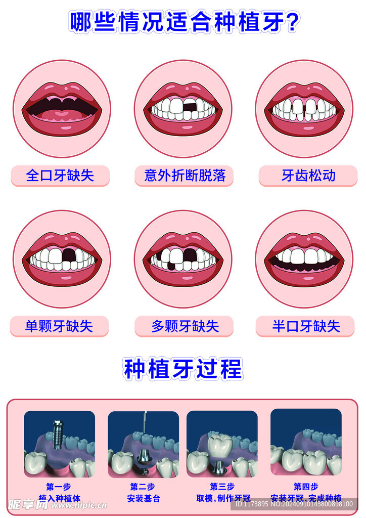 哪些情况适合种植牙