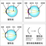 角膜塑形镜工作原理