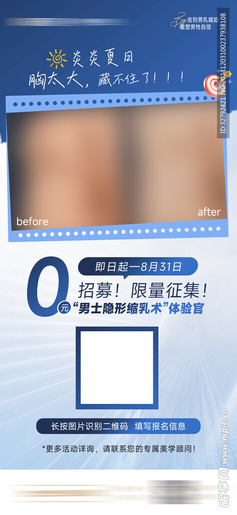 男士缩乳术整形矫正