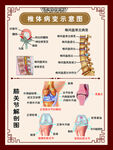 椎体病变示意图