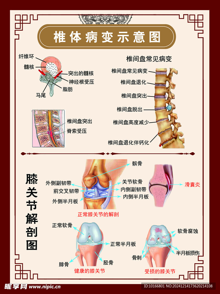 椎体病变示意图