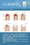 什么是根管治疗