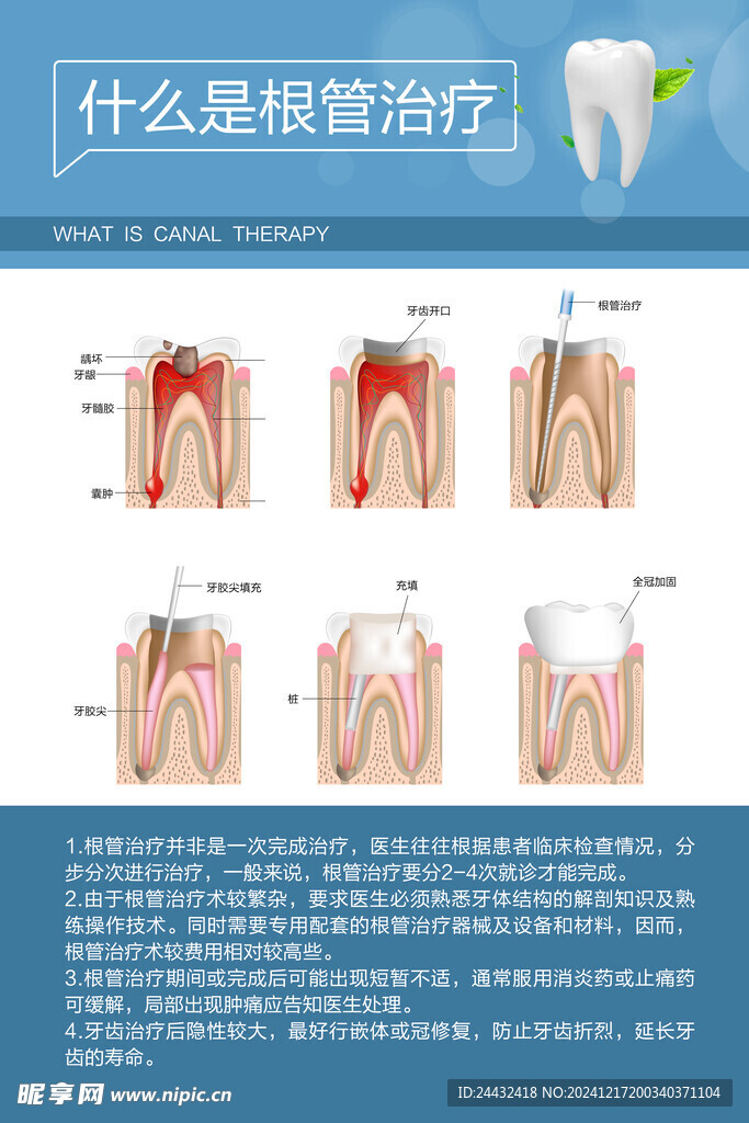 什么是根管治疗