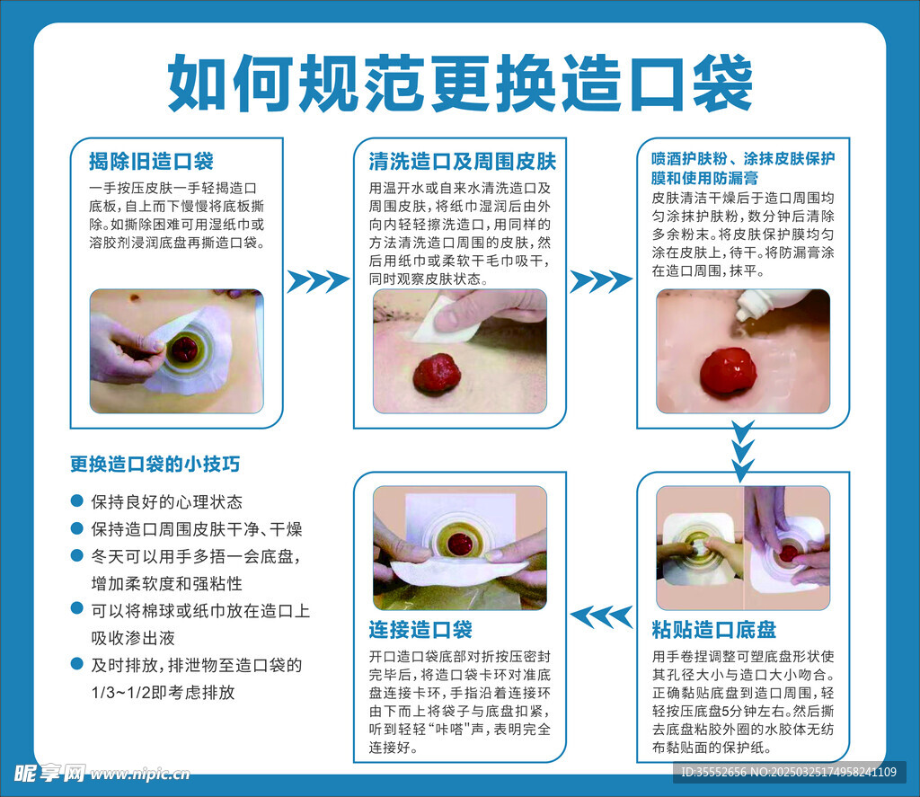 如何更换造口袋