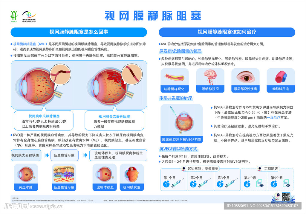 视网膜静脉阻塞