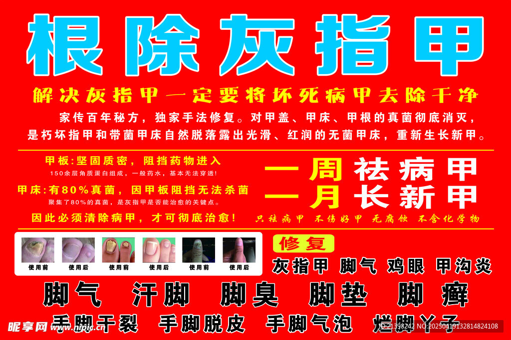根除灰指押