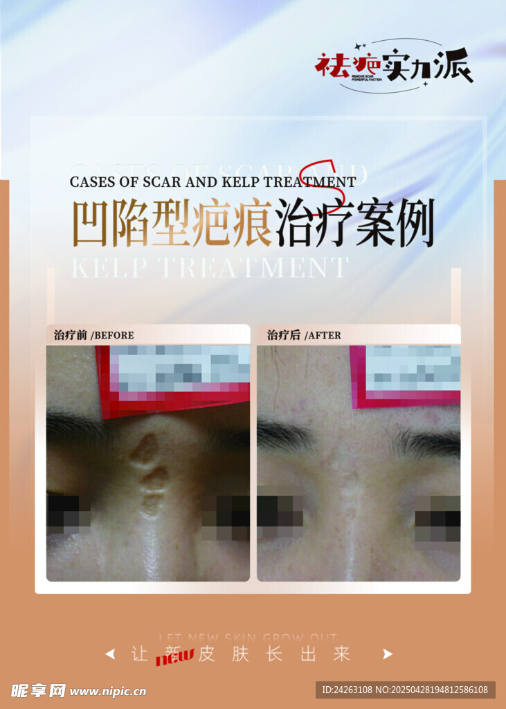 凹陷疤痕治疗案例展示