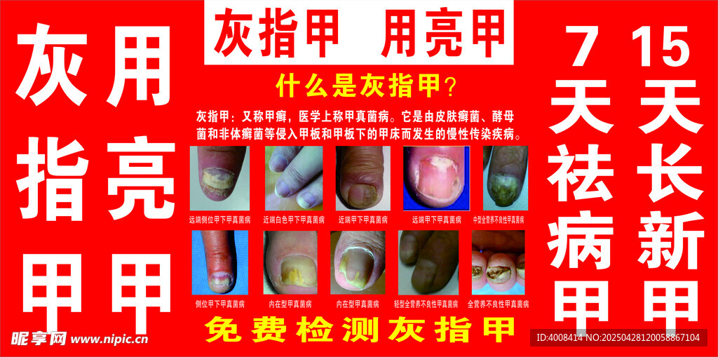 灰指甲