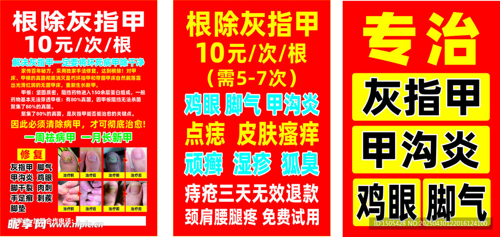 灰指甲 