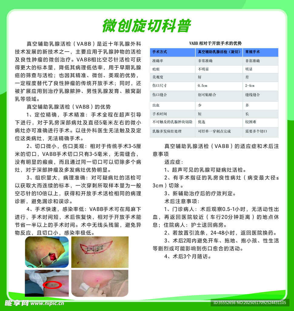 微创旋切科普