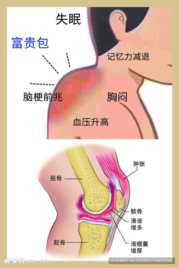 富贵包危害与膝盖问题图示