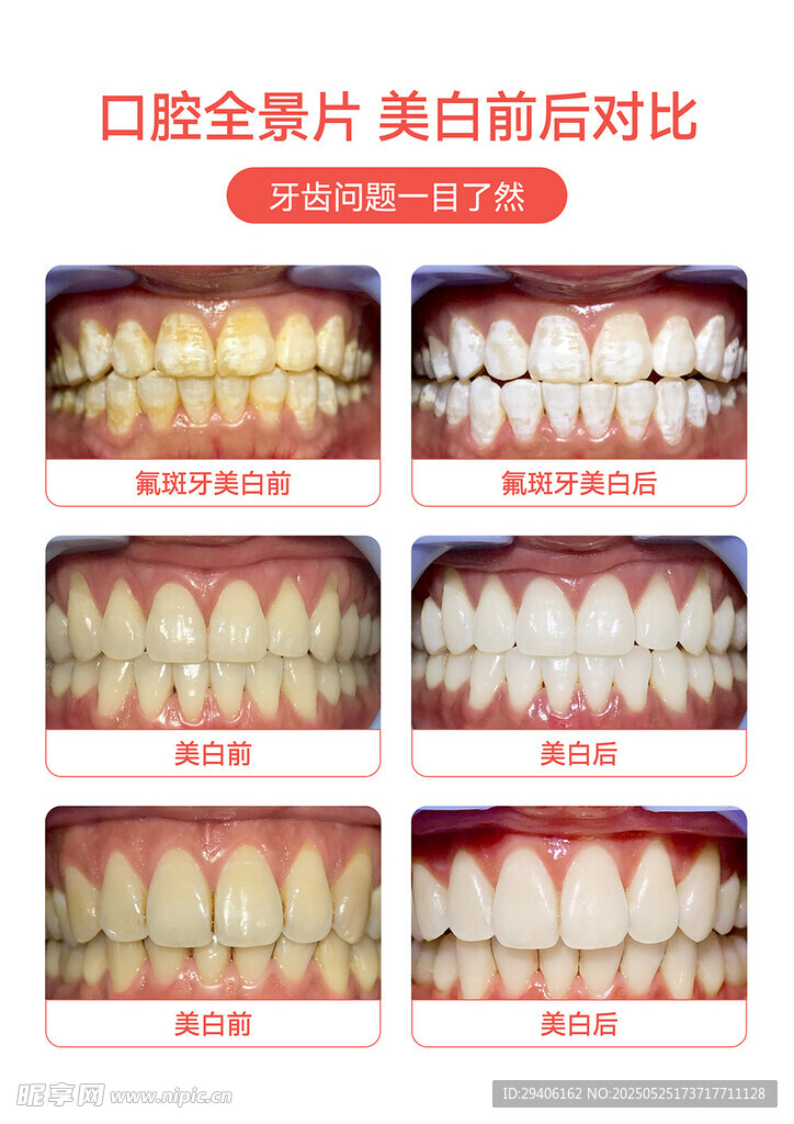 口腔牙科美白修复前后对比图