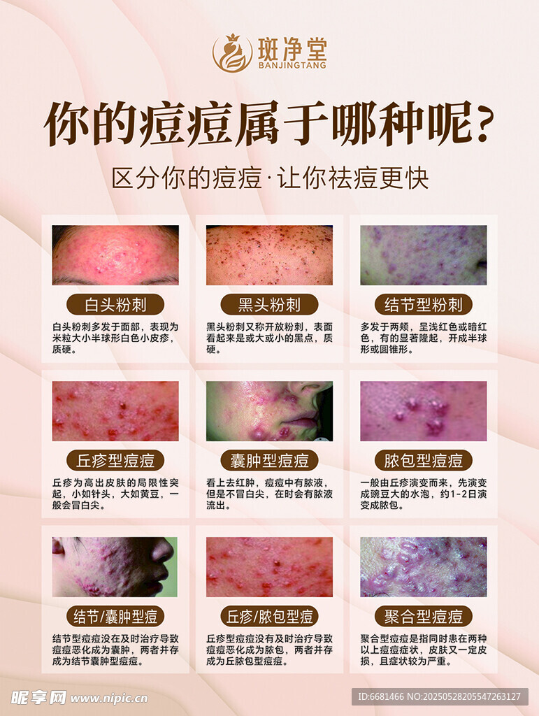 痘痘的分类