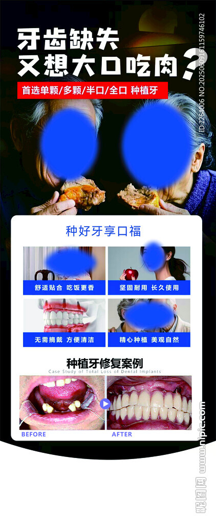 口腔种植宣传