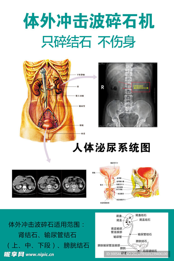 体外冲击波碎石机