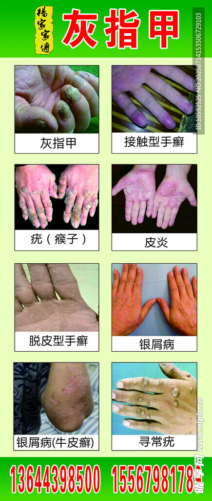 灰指甲