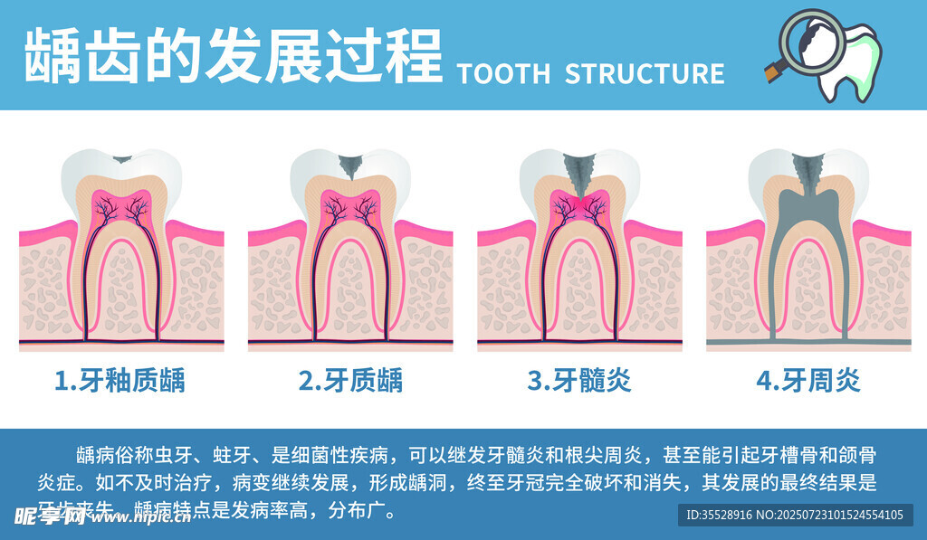 龋齿的发展过程