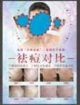 祛痘前后对比展示图