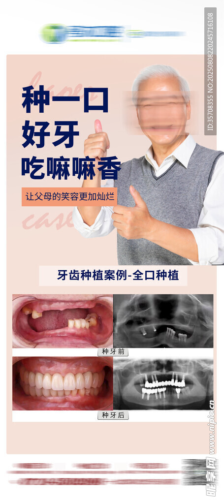 老人种植牙对比图
