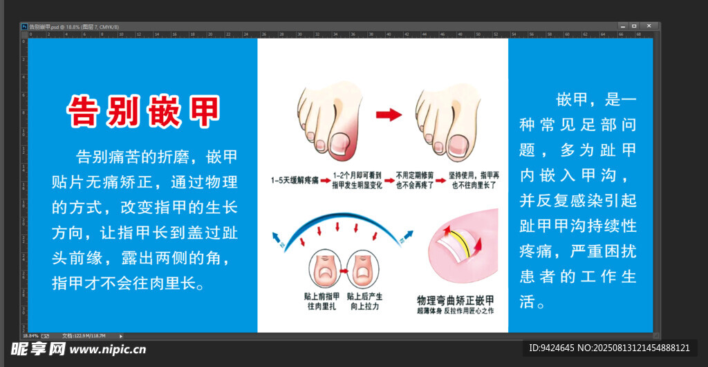 告别嵌甲 甲沟炎治疗