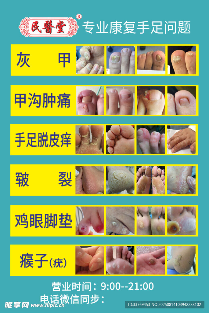 灰指甲