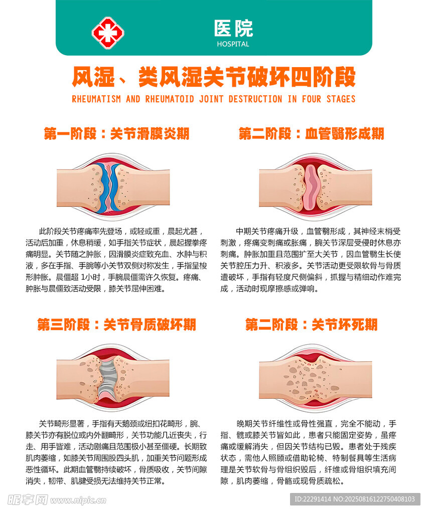 类风湿关节炎发展阶段