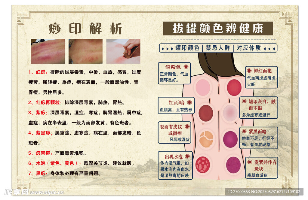 痧印解析  拔罐颜色辨健康