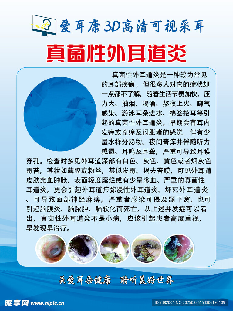 真菌性外耳道炎科普