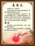 肩周炎
