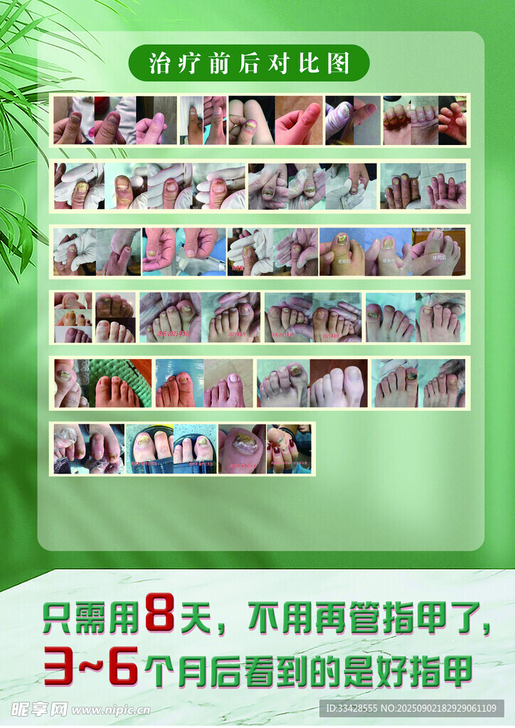 灰指甲