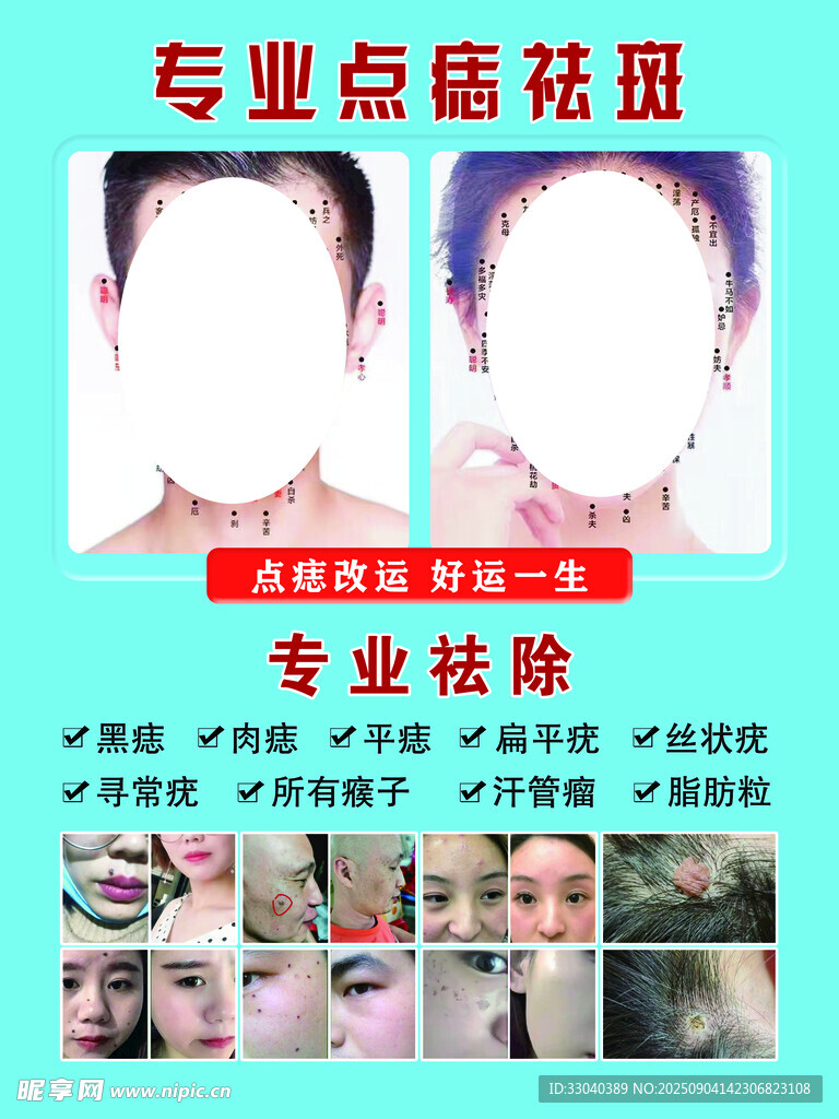 面部祛痣祛疣