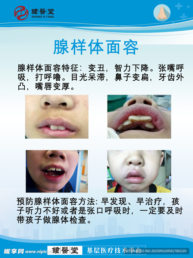 腺样体面容科普示例