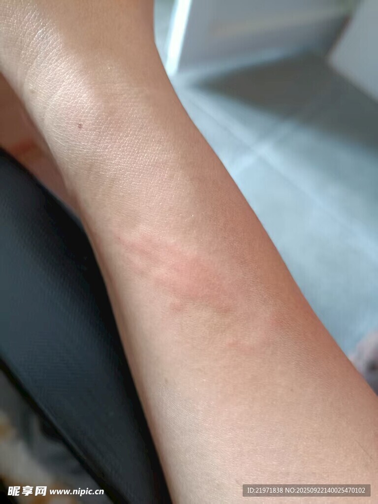 手臂上的皮肤痕迹