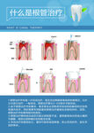 牙齿根管治疗科普图示