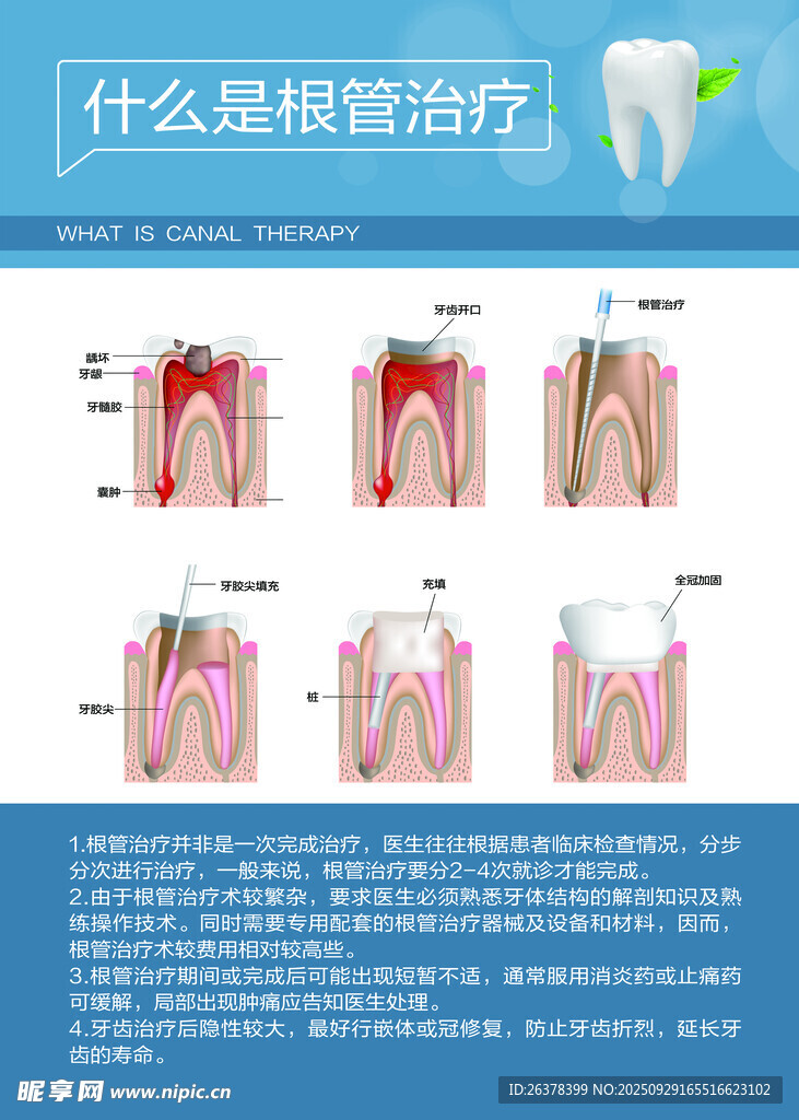 牙齿根管治疗科普图示